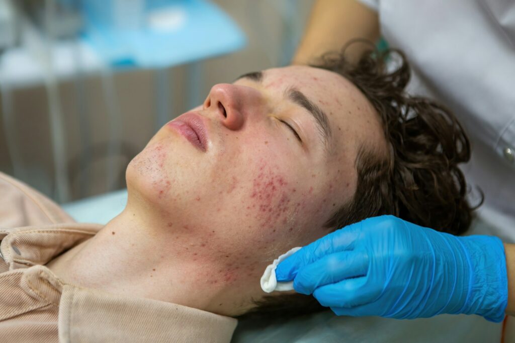 Treatment of acne in adolescents. Facial peeling to fight acne on the face